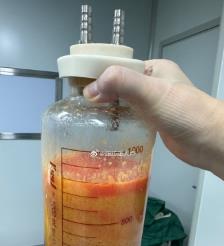鹿邑水动力吸脂手术要做多久？